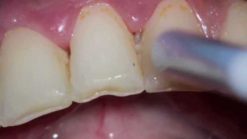 parodontoza
