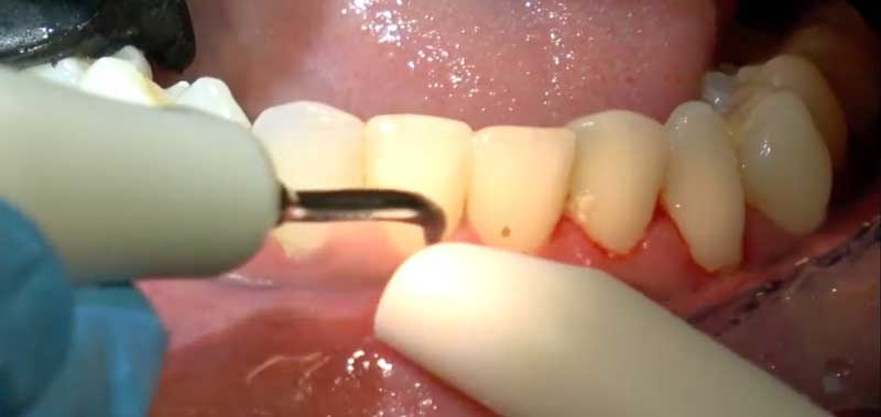 tehnici-chirurgicale-tratament-parodontoza