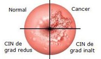 cancer-col-uterin
