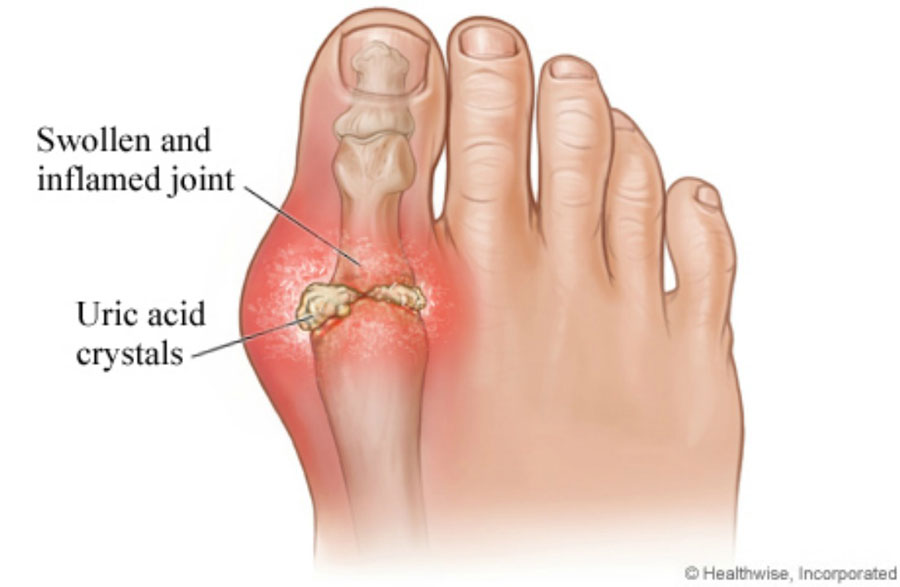 artroza articulației genunchiului după îndepărtarea meniscului