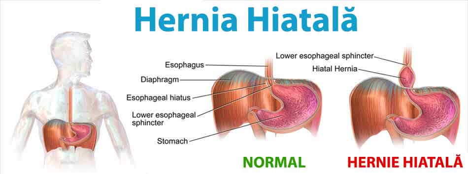 Hernia hiatala - simptome, diagnostic, tratament
