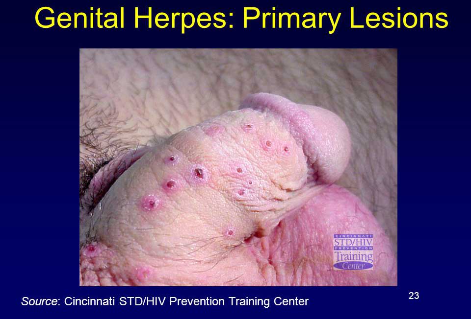 Herpes-Genital-pe-penis