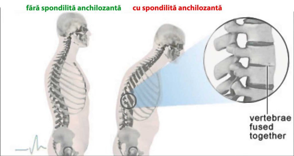 tratamentul homeopatic al artrozei articulare dureri musculare și articulare la nivelul articulației șoldului