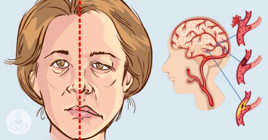 Cauzele si simptomele accidentului vascular cerebral – BIODEV MEDICAL CENTER IAŞI