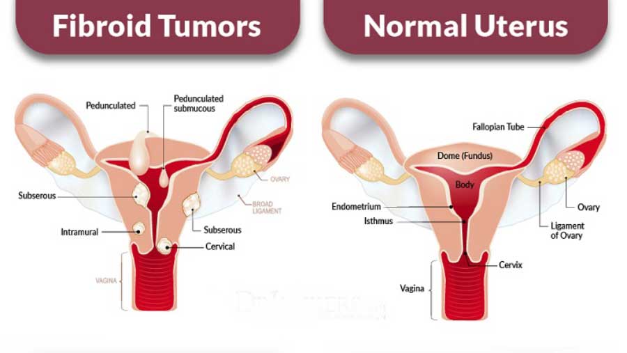 Sângerare cu fibroame uterine - Miom 