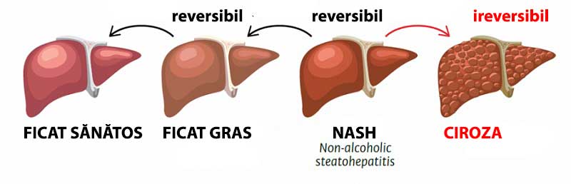 Boala hepatica generata de consumul de alcool