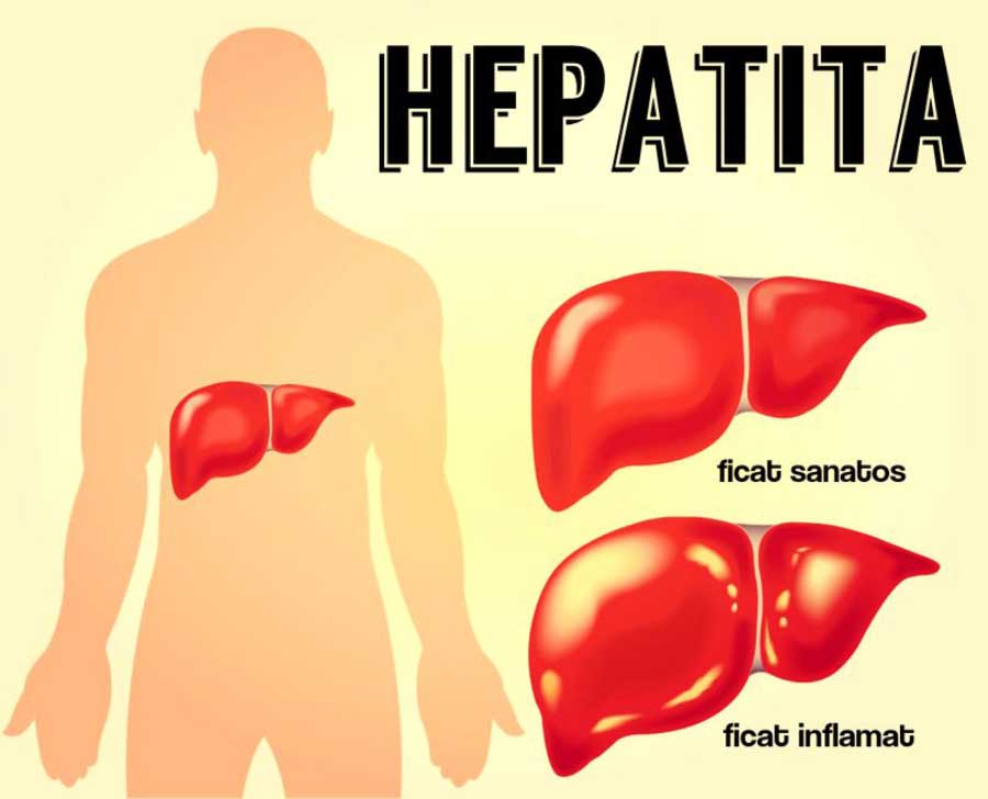 hepatita-a