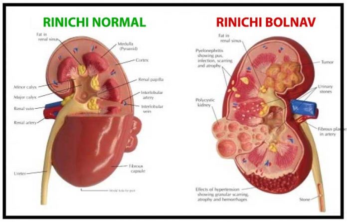simptome rinichi bolnavi
