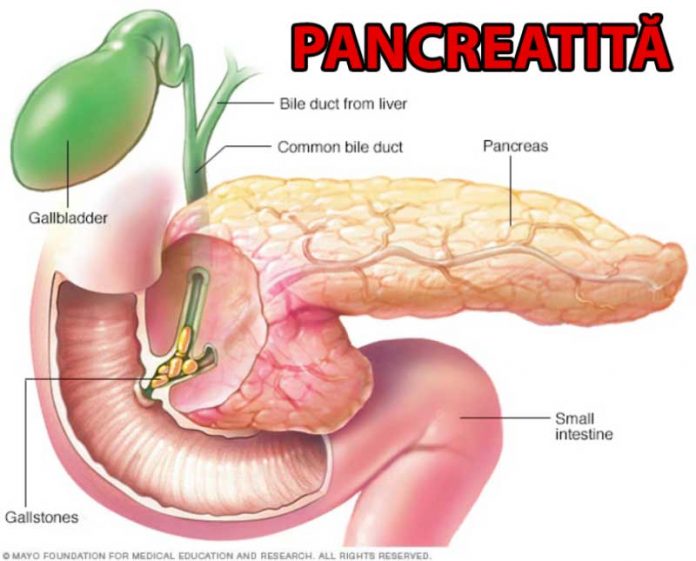 pancreatita cronică pierdere gravă în greutate