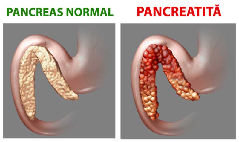 pancreatita-normala