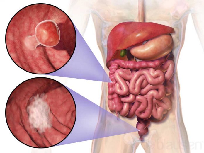 colon polyps simptome pierdere în greutate
