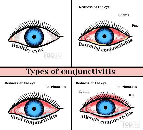 tratamentul conjunctivitei oftalmologice