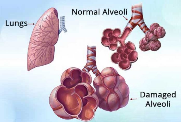 simptome pulmonare și tratament