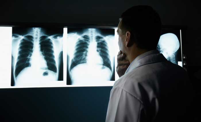 radiografie-tuberculoza