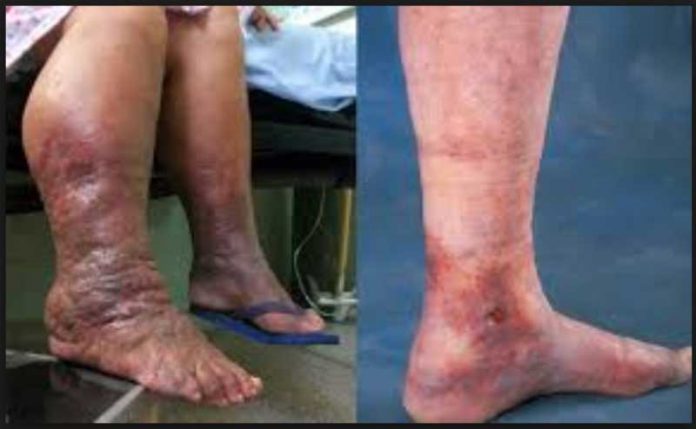 Venele pe picioare după operație - Complicaţiile - August
