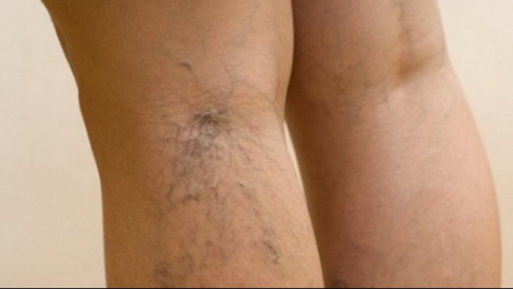 Varice - cauze, simptome si tratament Varicoza tratamentul piciorului barbailor
