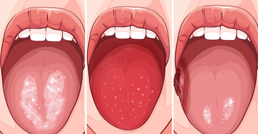 bacterii-pe-limba
