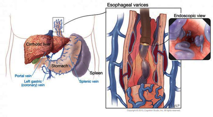 varicele-venoase-ale-esofagului