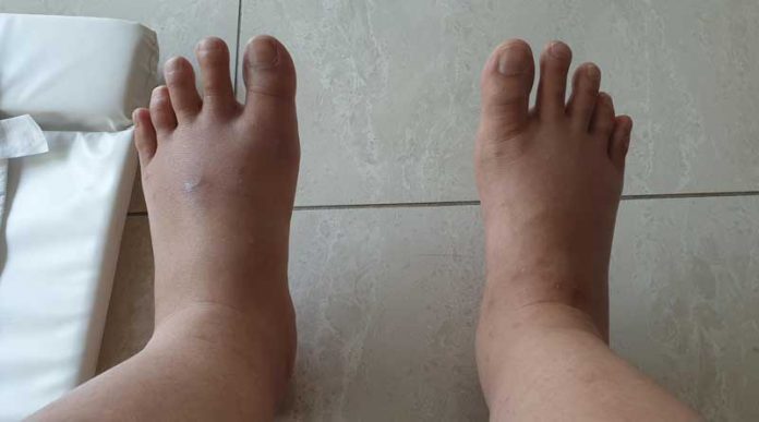 tratamentul picioarelor umflate în varicoza)