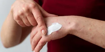 Eczema atopica nu este doar o afectiune a pielii